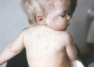 Measles.
